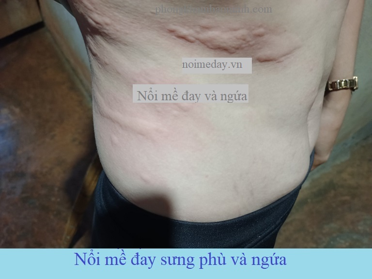 Cách trị nổi mề đay 